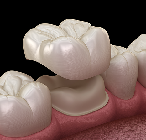 A 3D illustration of a crown being placed.